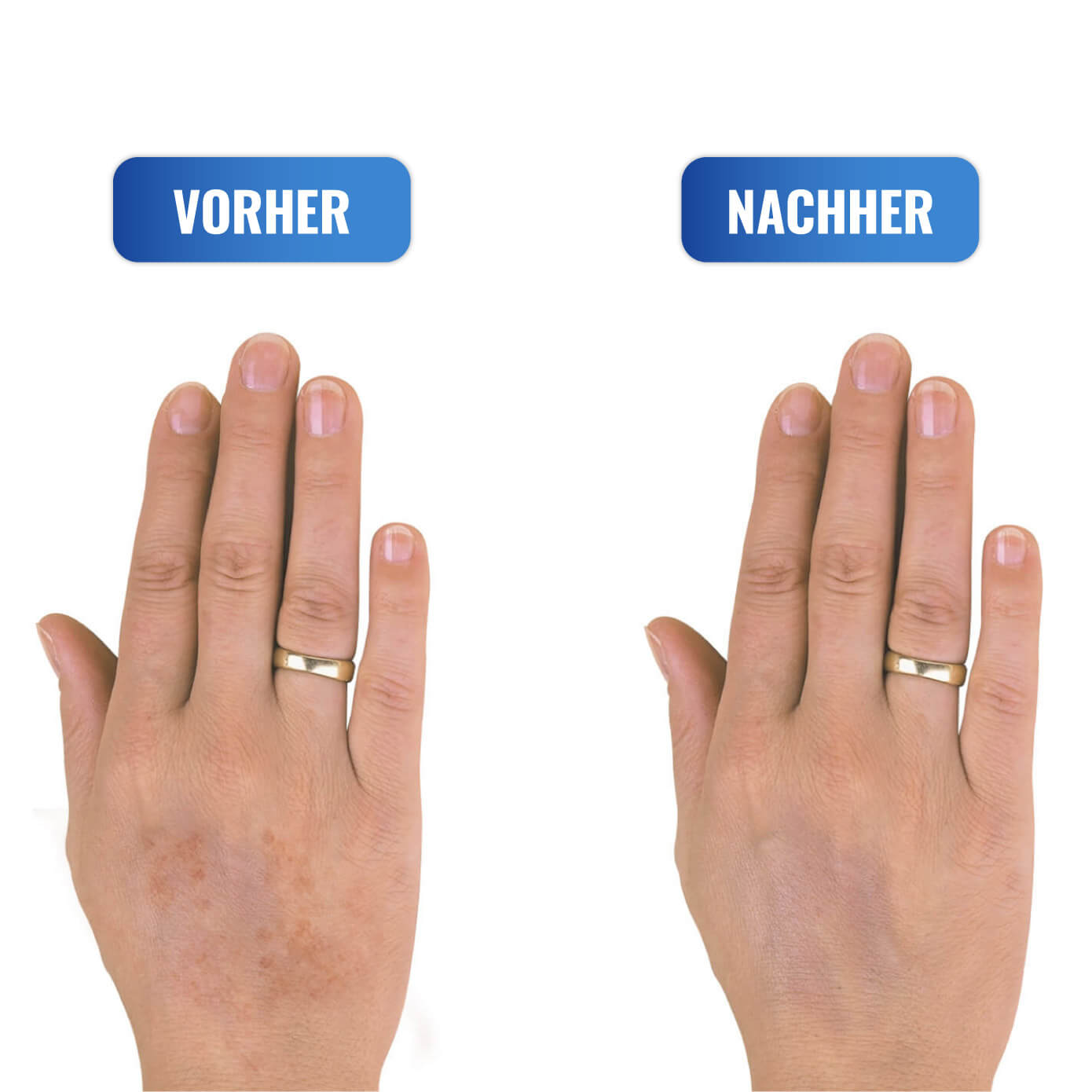 Altersflecken-Ex, 10 ml